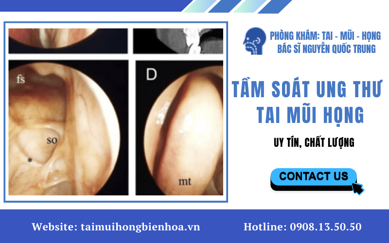 tầm soát ung thư tai mũi họng