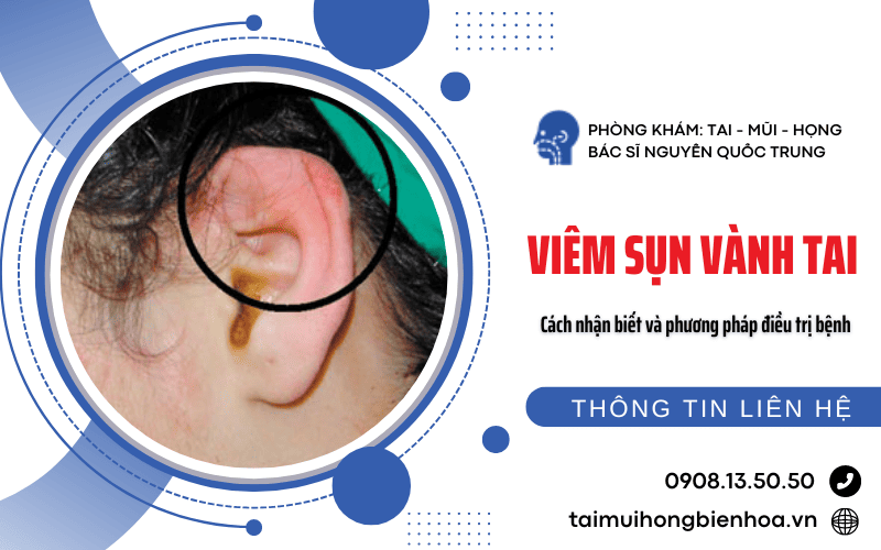 Viêm sụn vành tai