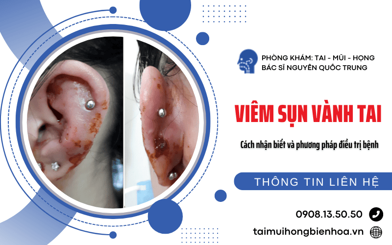 Viêm sụn vành tai