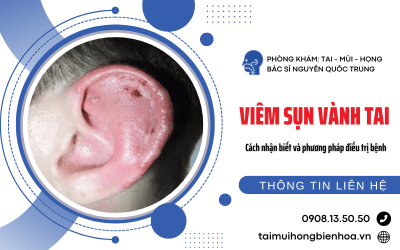 Viêm sụn vành tai